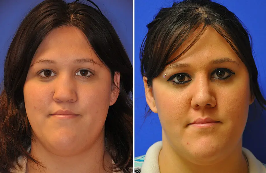 Revision Rhinoplasty Before and After Patient 2