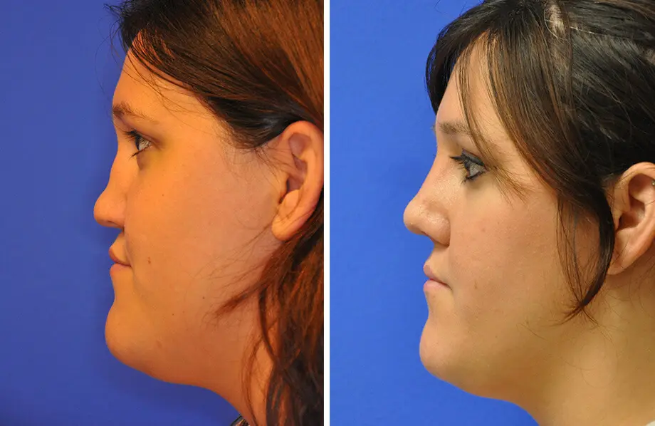 Revision Rhinoplasty Before and After Patient 1