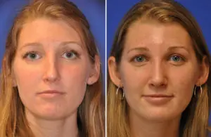 Revision Rhinoplasty Before and After Patient Thumbnail 3