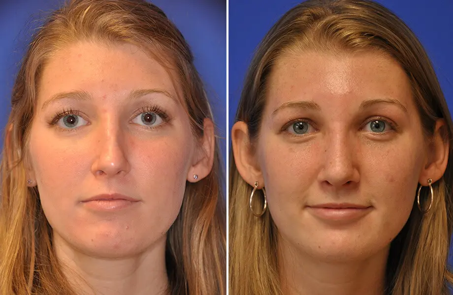 Revision Rhinoplasty Before and After Patient 3