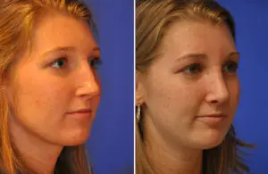 Revision Rhinoplasty Before and After Patient Thumbnail 4