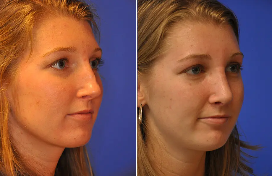 Revision Rhinoplasty Before and After Patient 4