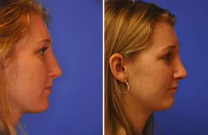 Revision Rhinoplasty Before and After Patient Thumbnail 2