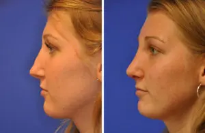Revision Rhinoplasty Before and After Patient Thumbnail 1