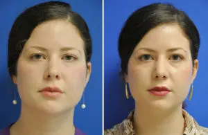 Revision Rhinoplasty Before and After Patient Thumbnail 3