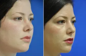 Revision Rhinoplasty Before and After Patient Thumbnail 4