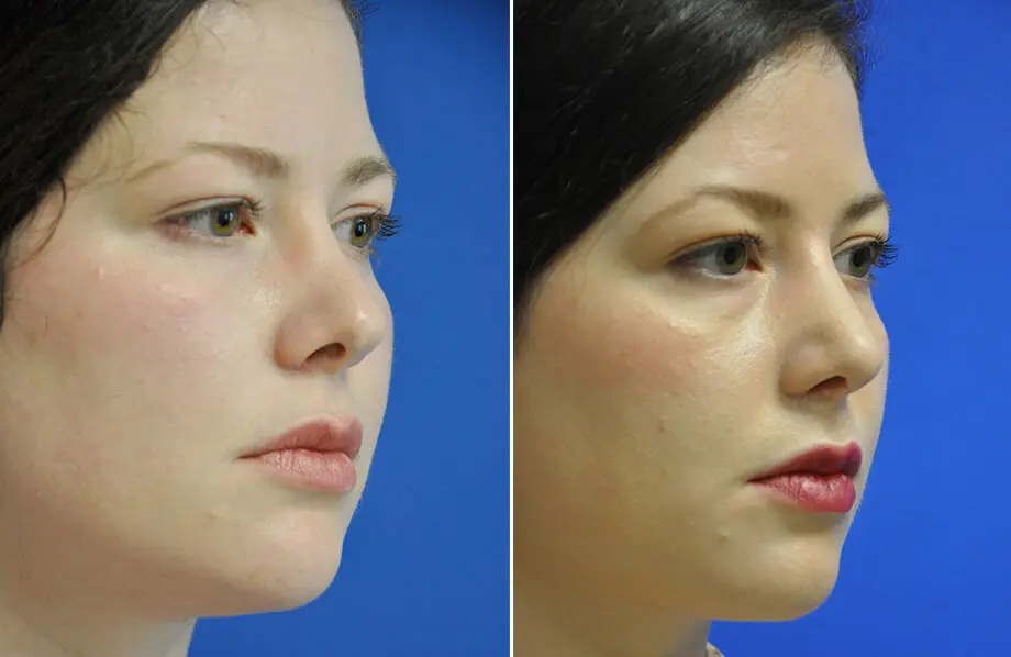Revision Rhinoplasty Before and After Patient 4