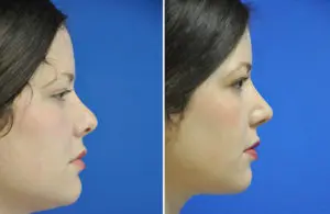 Revision Rhinoplasty Before and After Patient Thumbnail 2