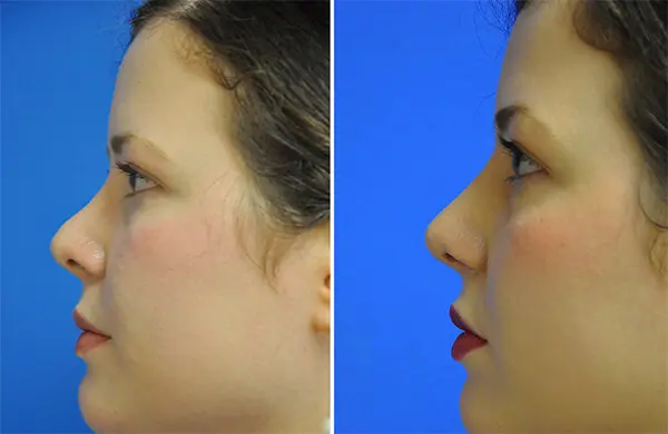 Revision Rhinoplasty Before and After Patient 1