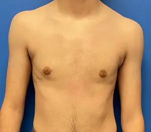 Top Surgery: FTM, Non Binary, Gender Nonconforming Before and After Patient Thumbnail 1
