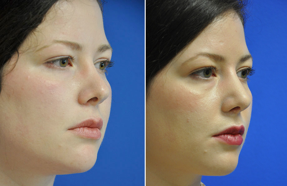 Top Guidelines Of Top Rhinoplasty Surgeon Austin