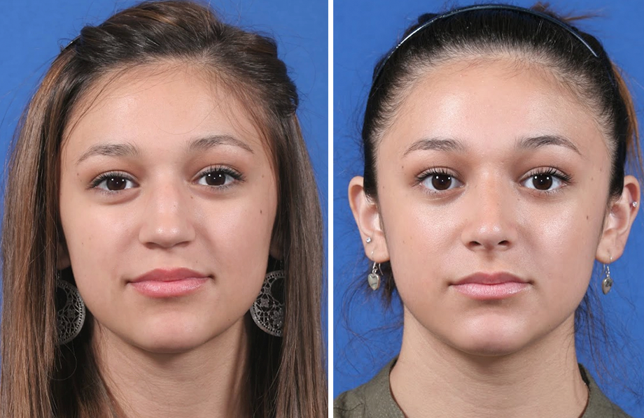 Rhinoplasty Surgery Austin Can Be Fun For Everyone