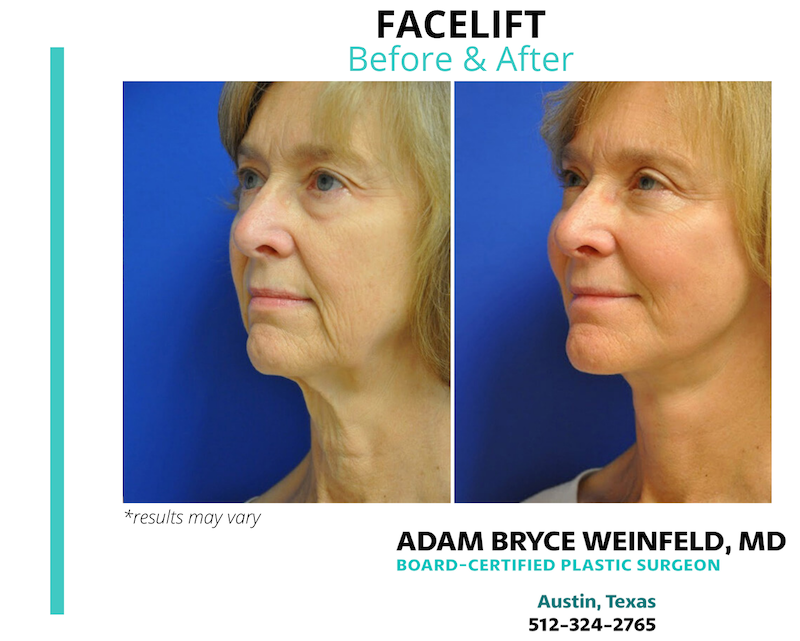 Before and after image of a facelift performed in Austin, TX.