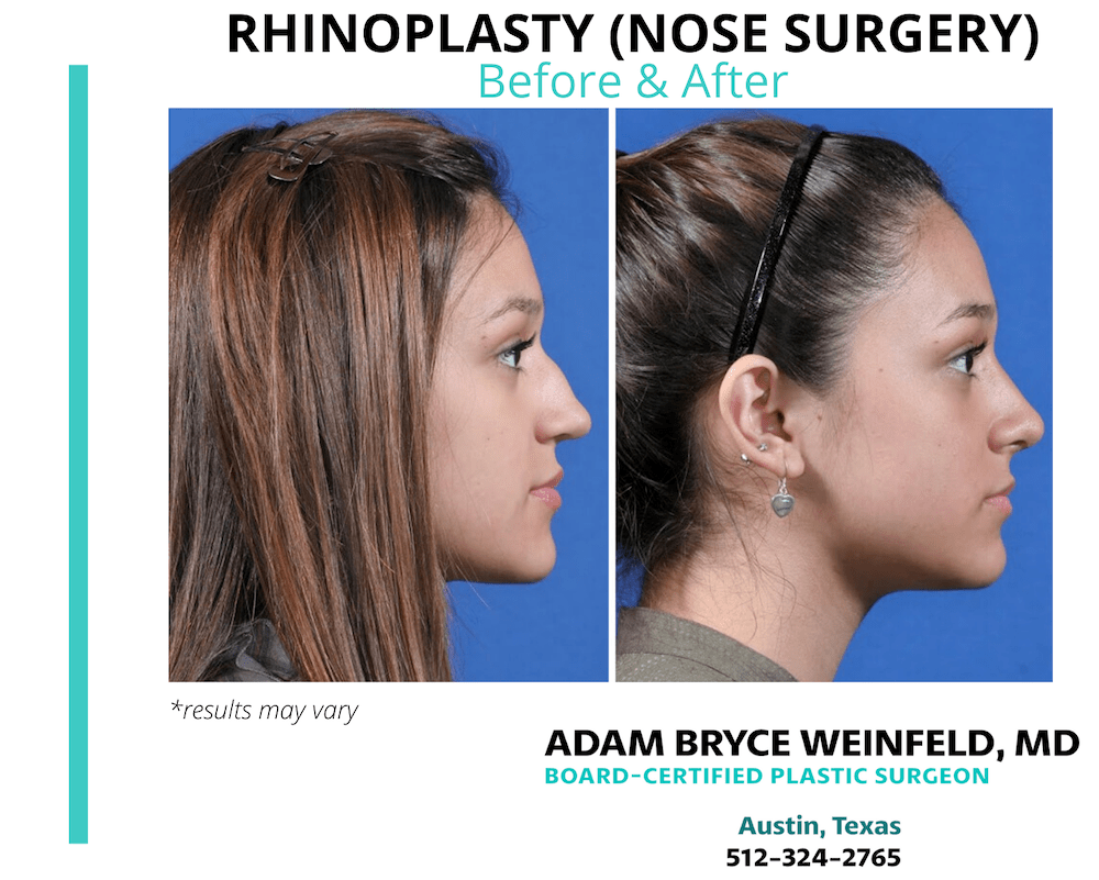 Before and after results showing rhinoplasty performed in Austin, TX.