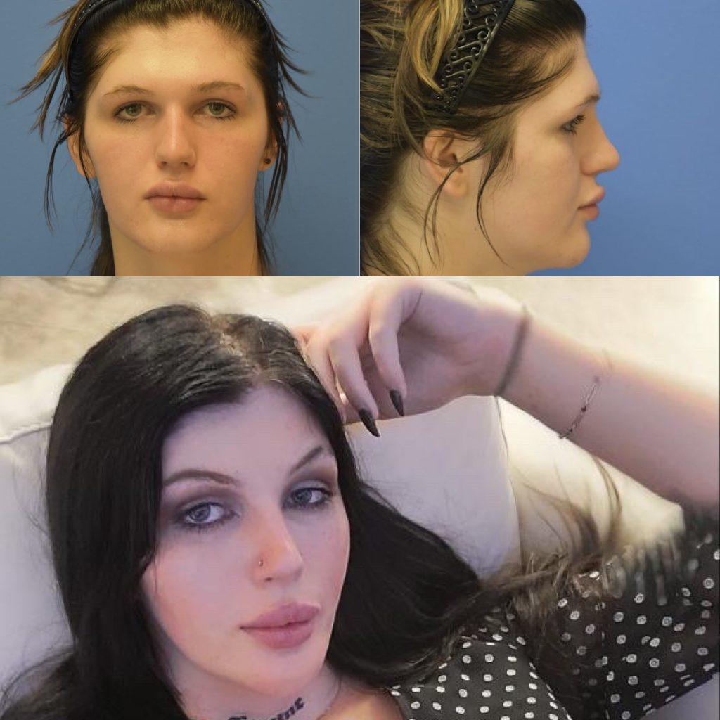 Before and after image of a patient who underwent facial feminization in Austin. TX.