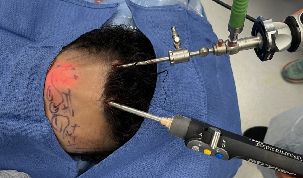 Patient undergoing forehead ridge surgery.