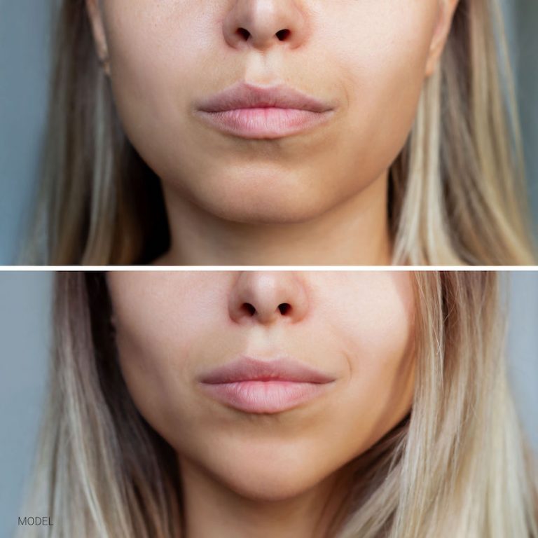 Your Top Chin Augmentation Options Dr. Weinfeld