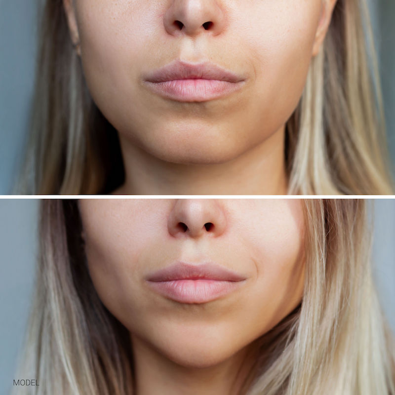 Woman before and after chin surgery.