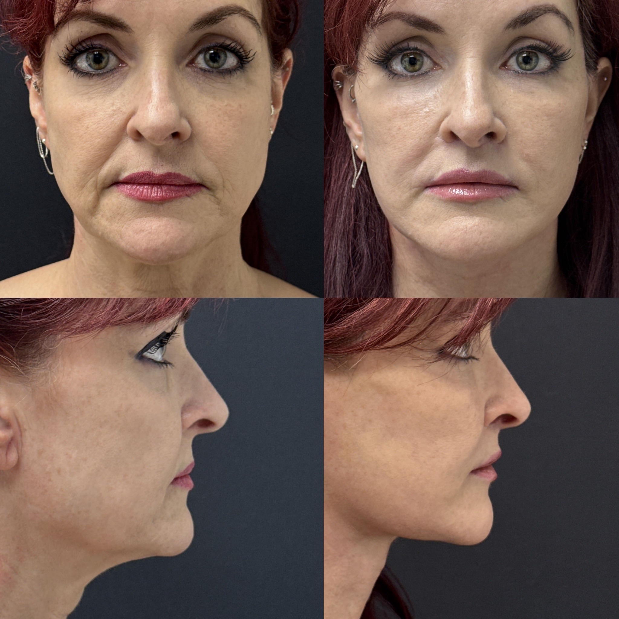 Before and after photos of a patient who underwent both a bullhorn lip lift and a lateral commissure triangle lift, showing comprehensive rejuvenation of the central and outer portions of the upper lip