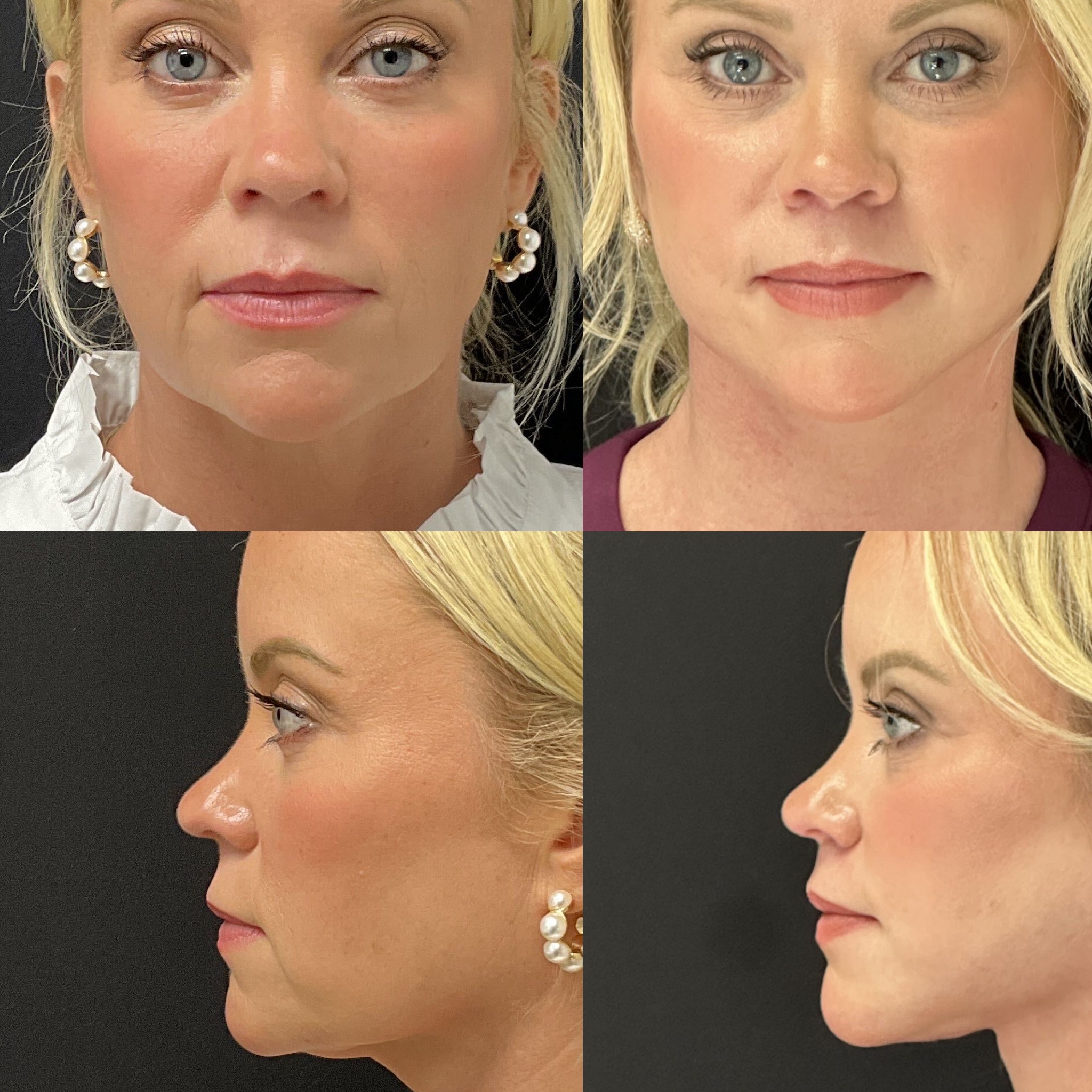 Before and after photos of a woman who underwent a central bullhorn lip lift combined with a facelift, showing a shorter upper lip and increased vermilion show