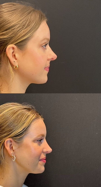 Revision rhinoplasty right side view before and after