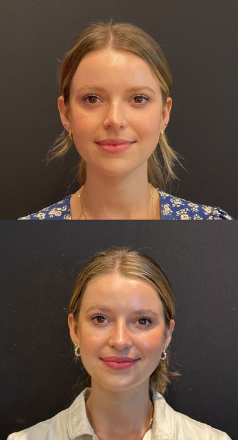 Revision rhinoplasty front view before and after