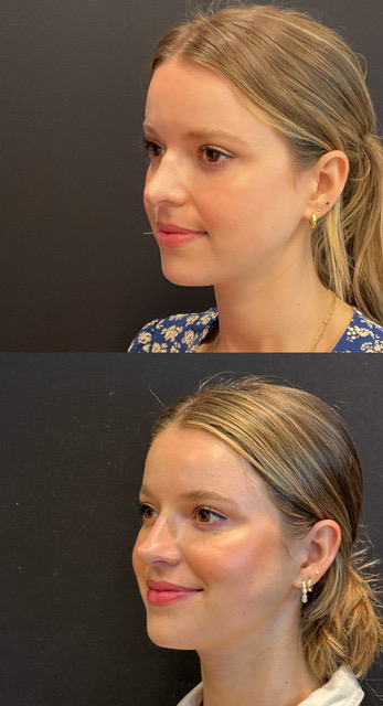 Revision rhinoplasty left oblique view before and after