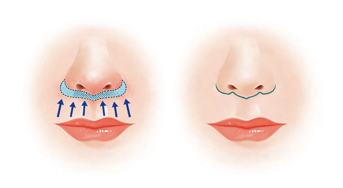 Diagram illustrating the bullhorn lip lift incision pattern at the base of the nose, showing how the central upper lip is shortened and vermilion show is increased
