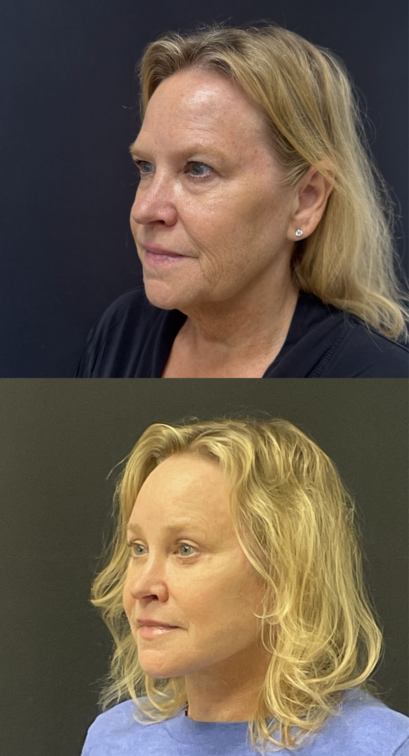 Before and after deep plane facelift by Dr. Adam Weinfeld, Austin TX — showing improved facial contour, malar projection, and jawline definition