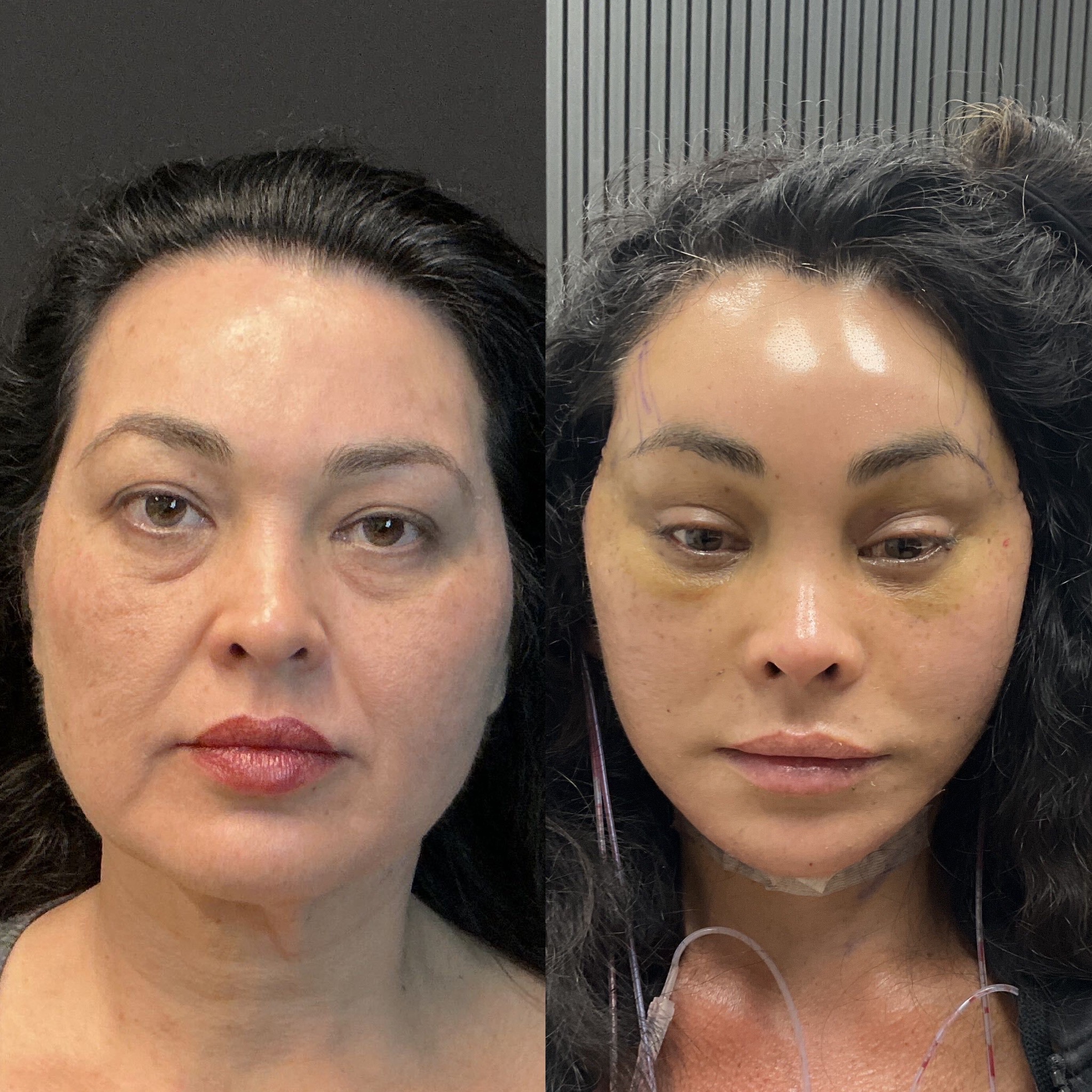Frontal view of a patient three days after TriMax deep plane facelift, deep plane neck lift, endoscopic brow lift, fat grafting to the temples cheeks and lips, and micro liposuction to the nasolabial folds and jowls — performed by Austin facial plastic surgeon Dr. Adam Weinfeld