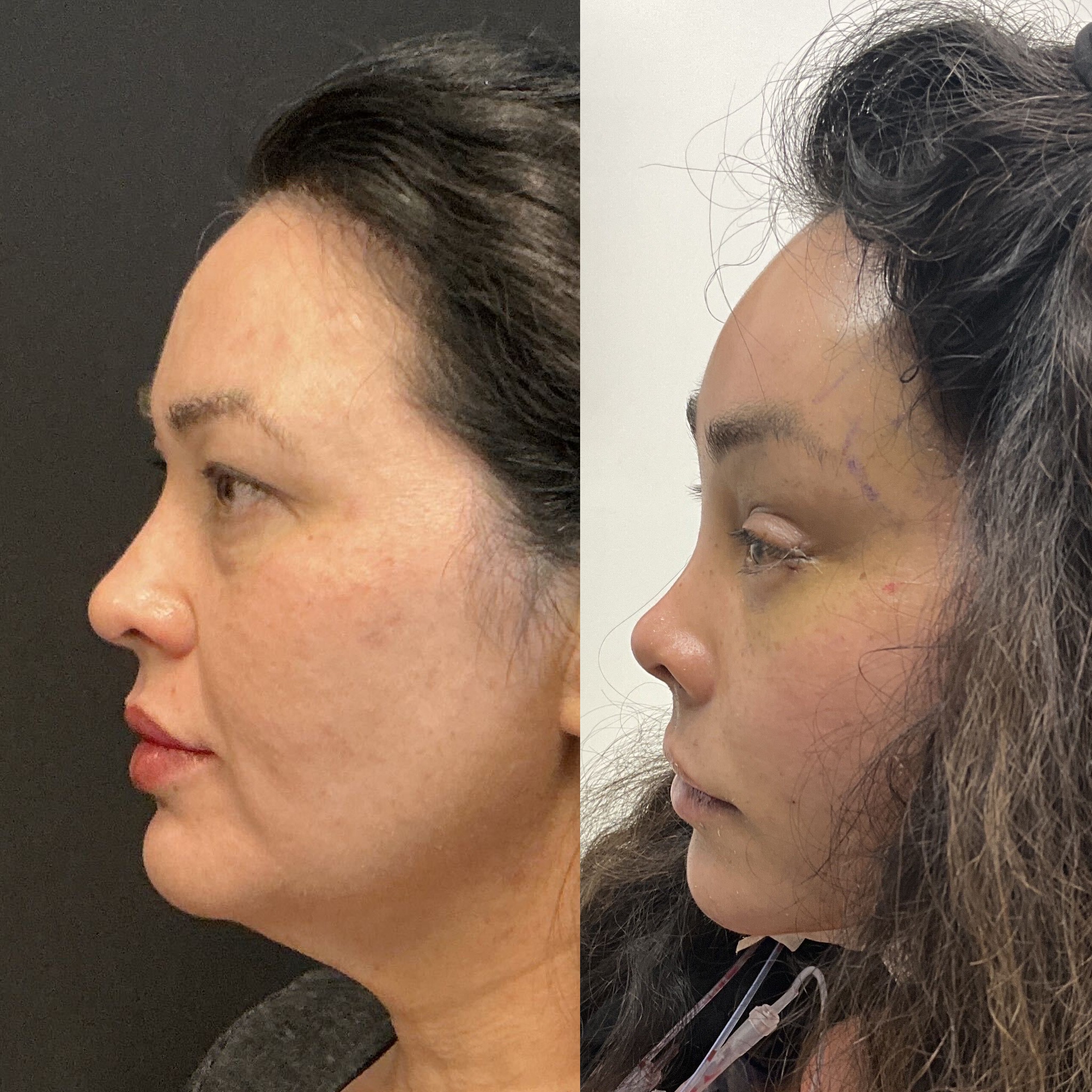 Left side view of a patient three days after TriMax deep plane facelift, deep plane neck lift, endoscopic brow lift, fat grafting to the temples cheeks and lips, and micro liposuction to the nasolabial folds and jowls — performed by Austin facial plastic surgeon Dr. Adam Weinfeld