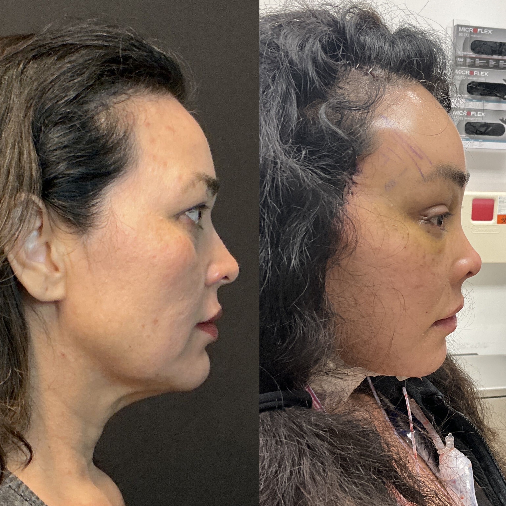 Right side view of a patient three days after TriMax deep plane facelift, deep plane neck lift, endoscopic brow lift, fat grafting to the temples cheeks and lips, and micro liposuction to the nasolabial folds and jowls — performed by Austin facial plastic surgeon Dr. Adam Weinfeld