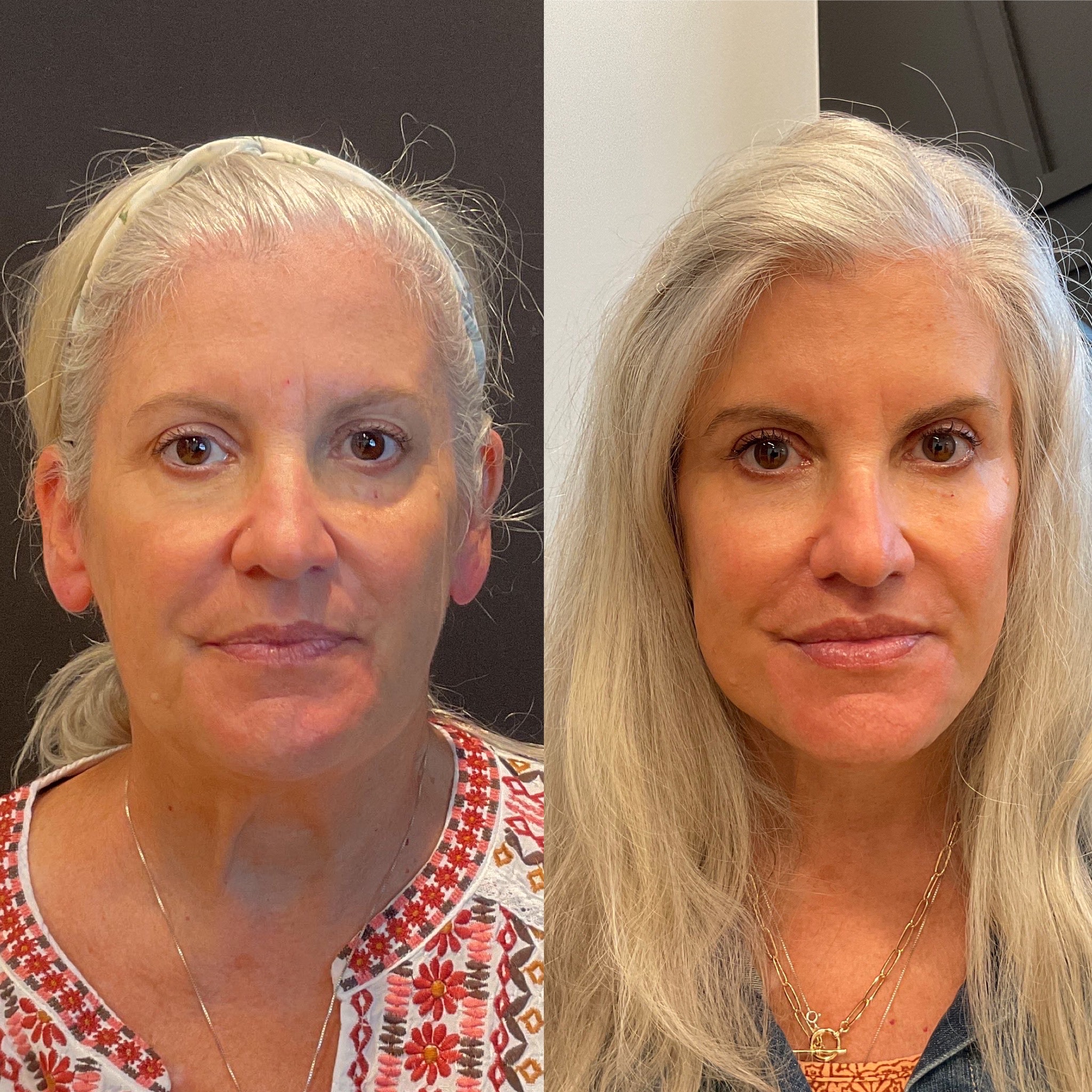 Front view before and after high SMAS facelift by Dr. Adam Weinfeld, Austin TX