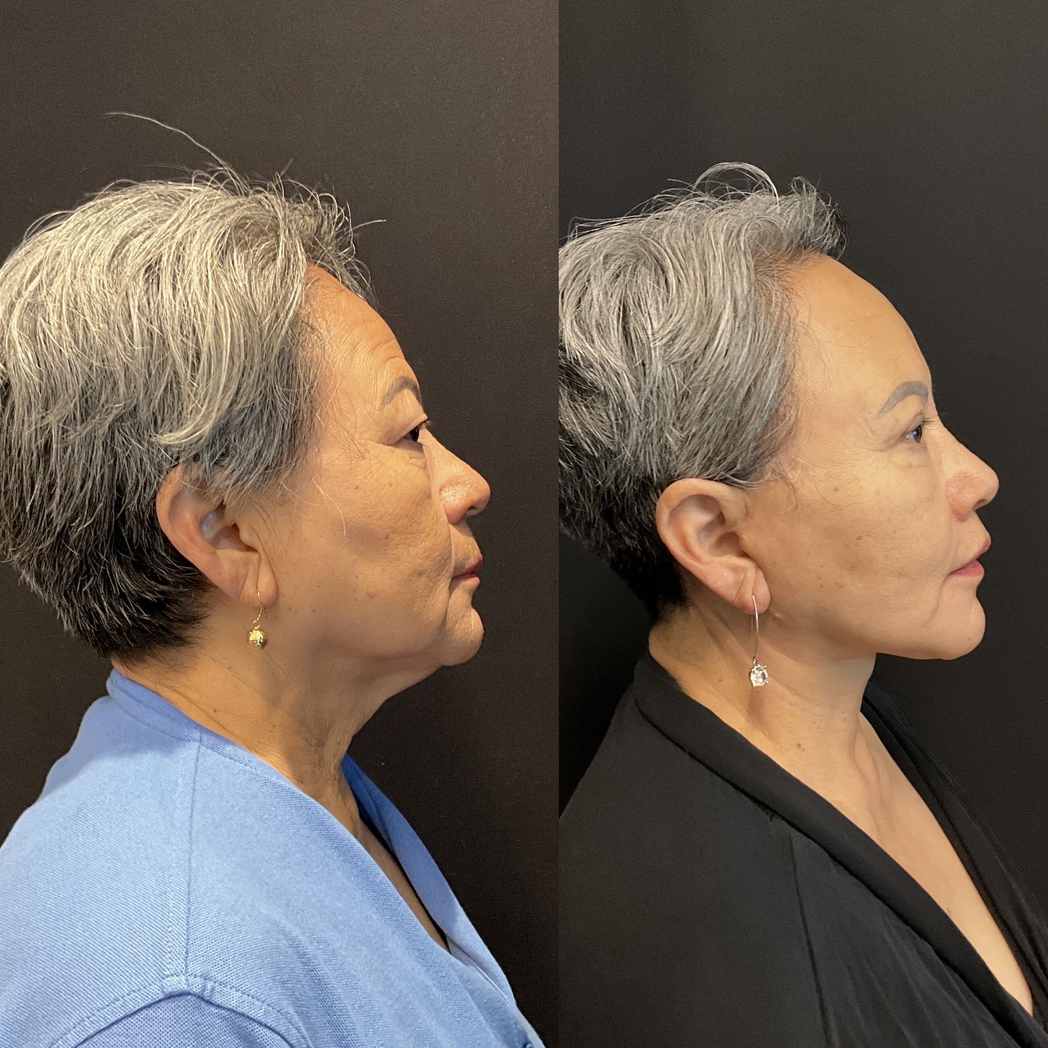 Side view before and after deep plane facelift by Dr. Adam Weinfeld, Austin TX