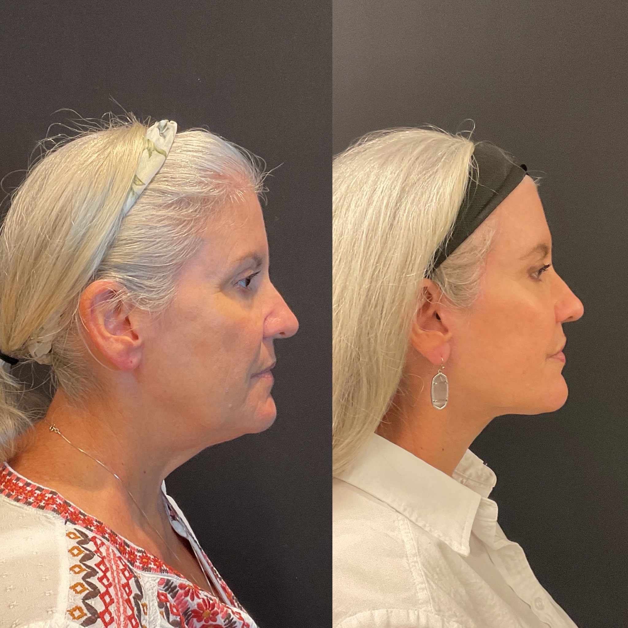 Side view before and after high SMAS facelift by Dr. Adam Weinfeld, Austin TX