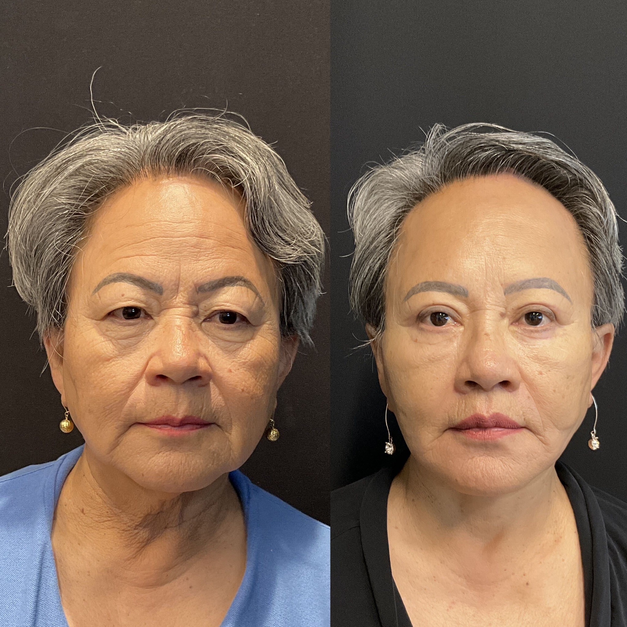 Front view before and after deep plane facelift by Dr. Adam Weinfeld, Austin TX