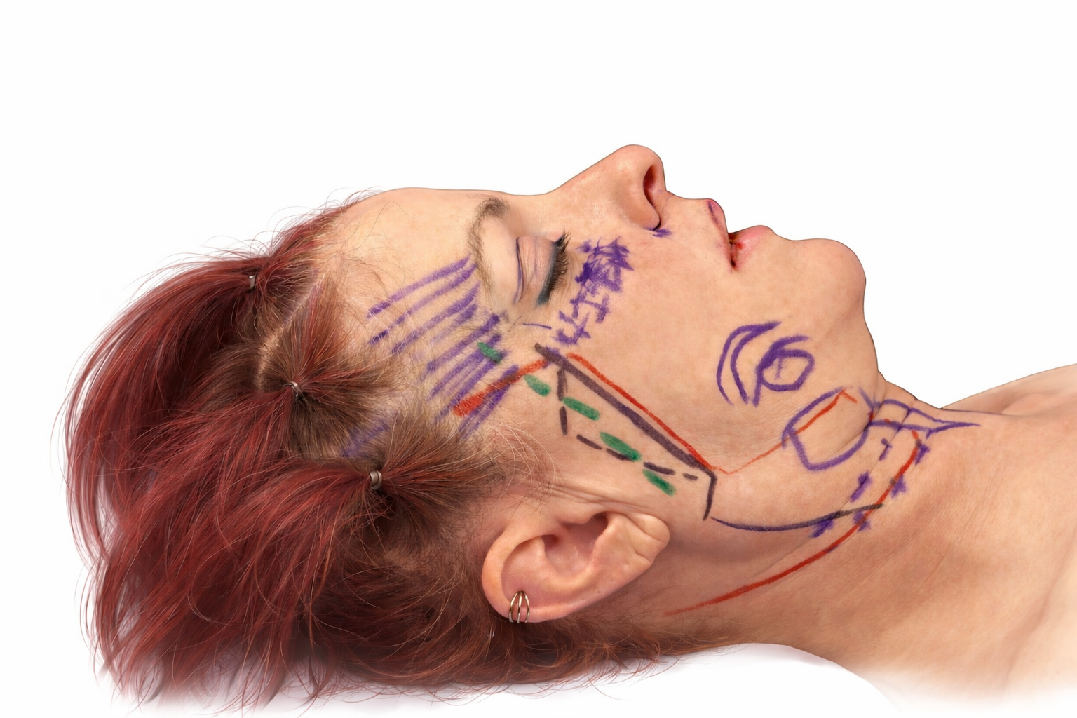Female patient with preoperative facial markings for deep plane facelift, showing entry points, skin elevation zones, fat grafting areas on the cheeks and neck, micro-liposuction along the jawline, and submandibular gland reduction marking