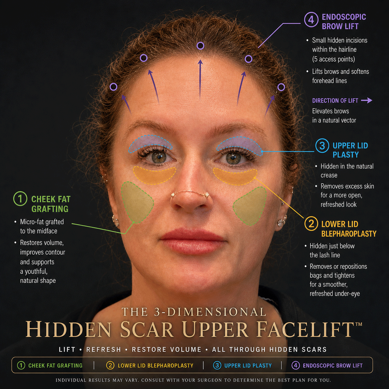 Infographic showing the four components of the 3-Dimensional Hidden Scar Upper Facelift — cheek fat grafting, lower lid blepharoplasty, upper lid plasty, and endoscopic brow lift — Dr. Adam Weinfeld Austin TX
