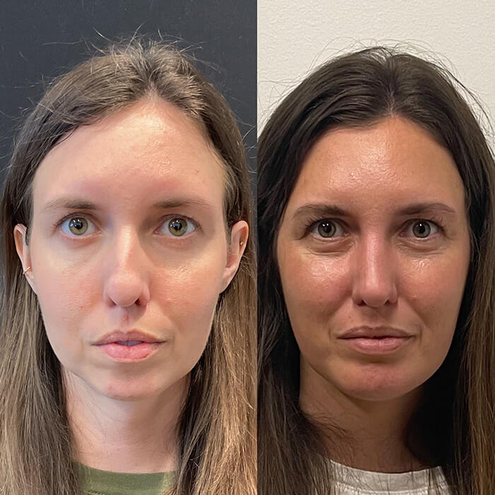 Rhinoplasty Before and After Patient 3