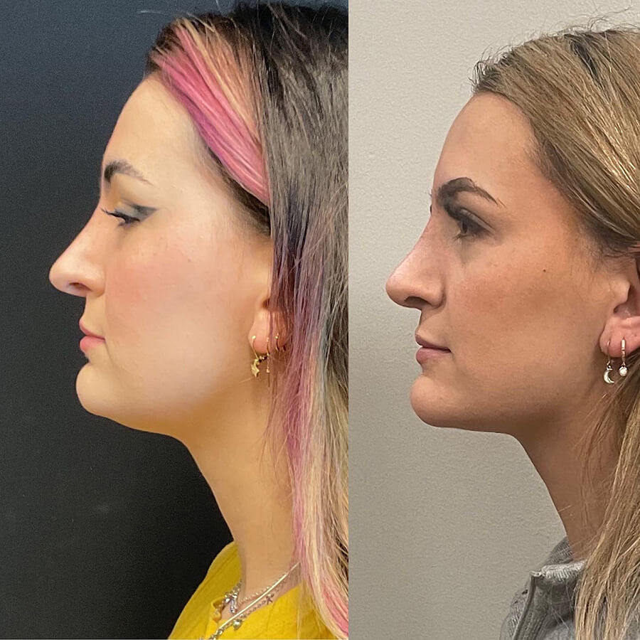 Face Before and After Patient 2
