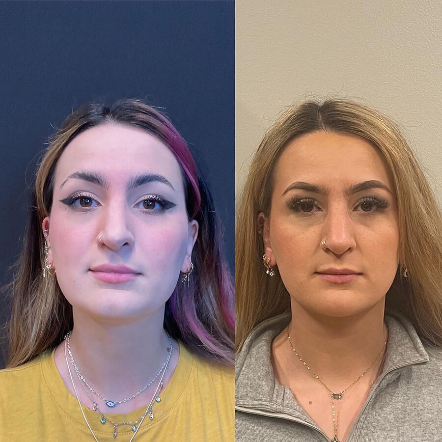 Face Before and After Patient 3