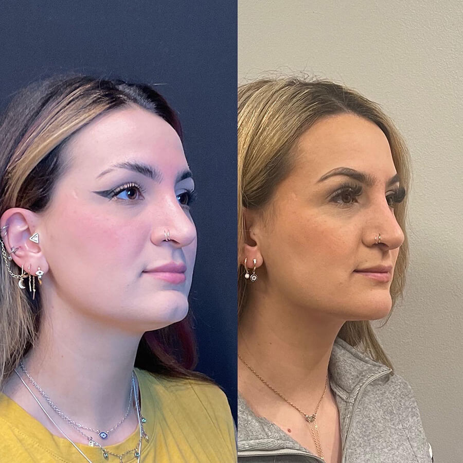 Face Before and After Patient 4