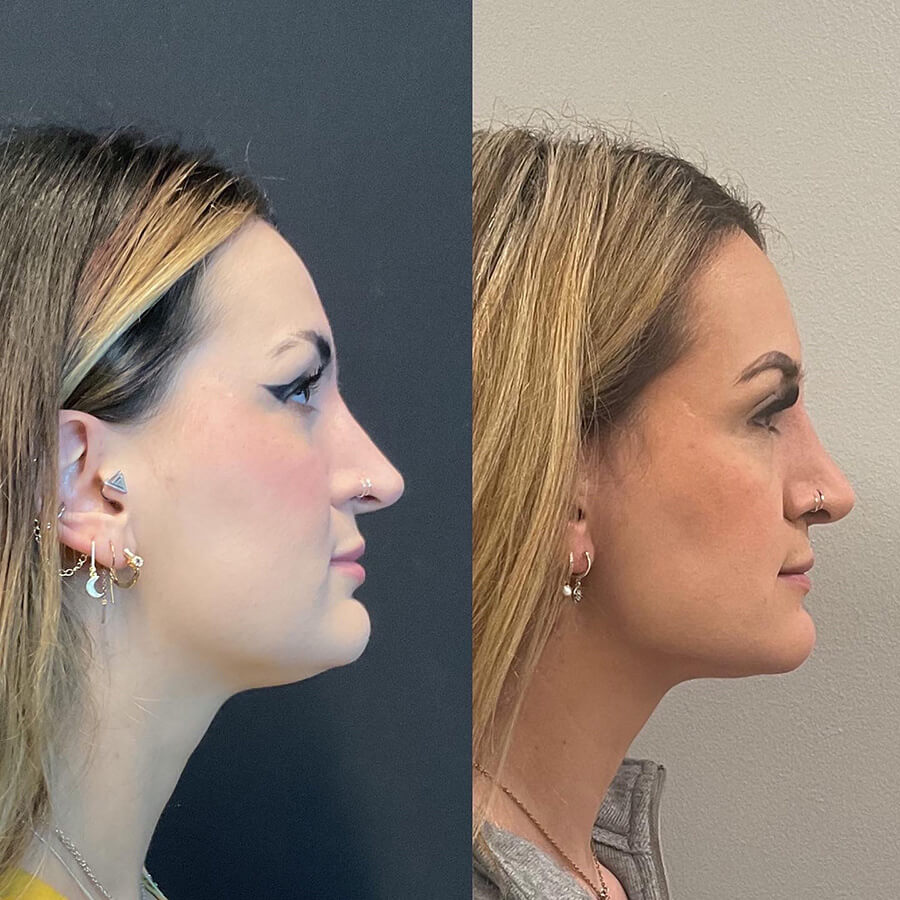 Face Before and After Patient 5