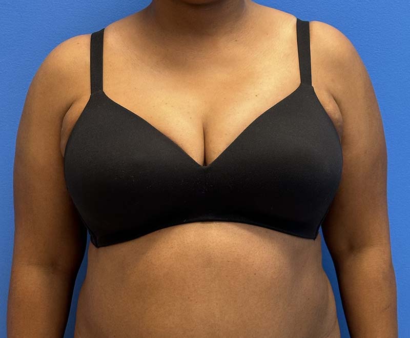 Breast Before and After Patient 1