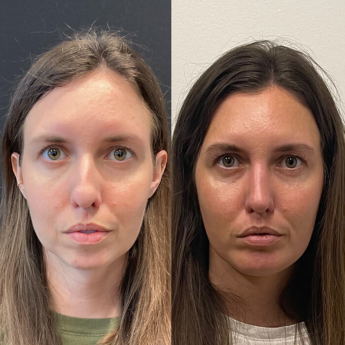 Rhinoplasty Before and After Patient 4
