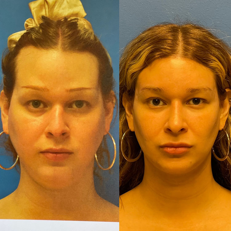 Buccal Fat Pad Reduction Before and After Patient 1