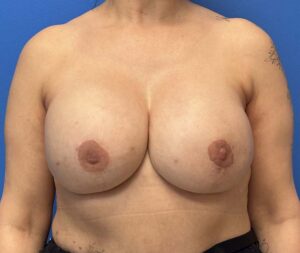 Breast Reconstruction Before and After Patient Thumbnail 2