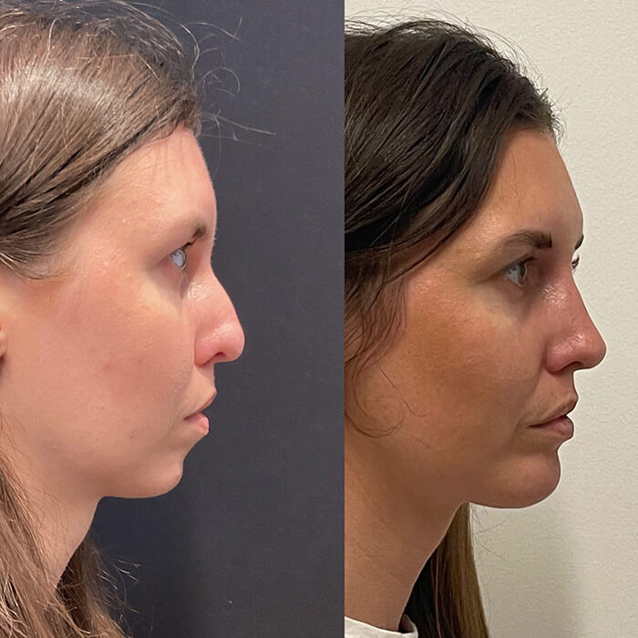 Rhinoplasty Before and After Patient 1