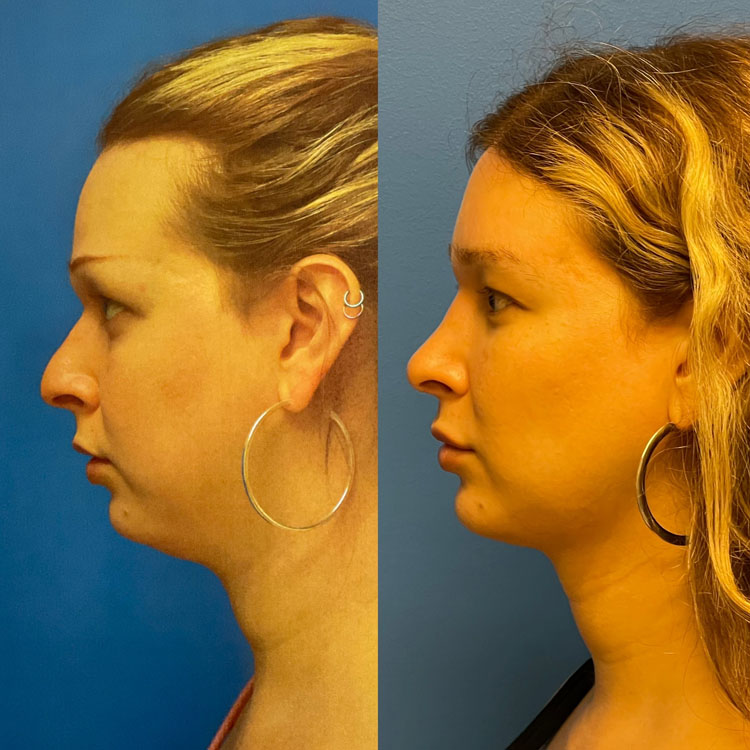Facial Feminization Before and After Patient 2