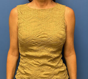 Breast Reconstruction Before and After Patient Thumbnail 3